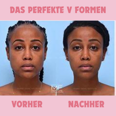 1+1 Gratis | FaceShape - Vakuum-Gesichtstrainer
