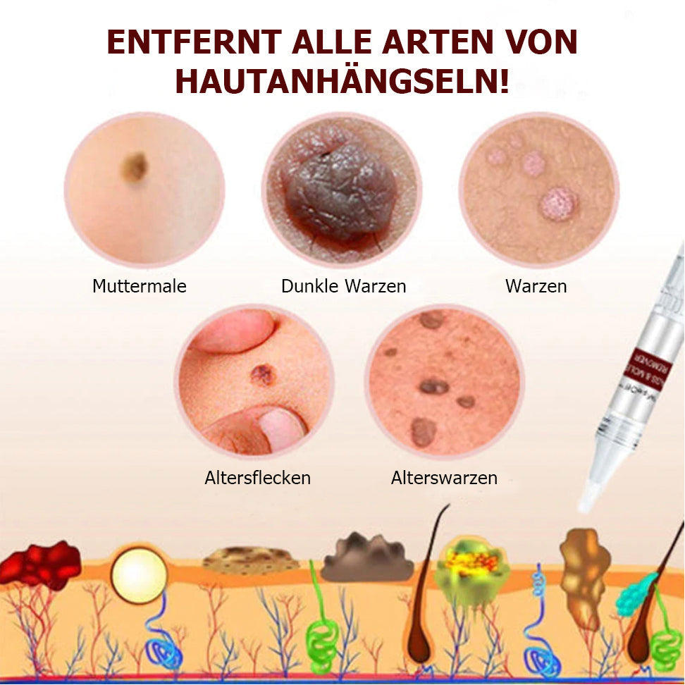 1+1 Gratis | WipeOff - Hautmakel- und Muttermal Entferner