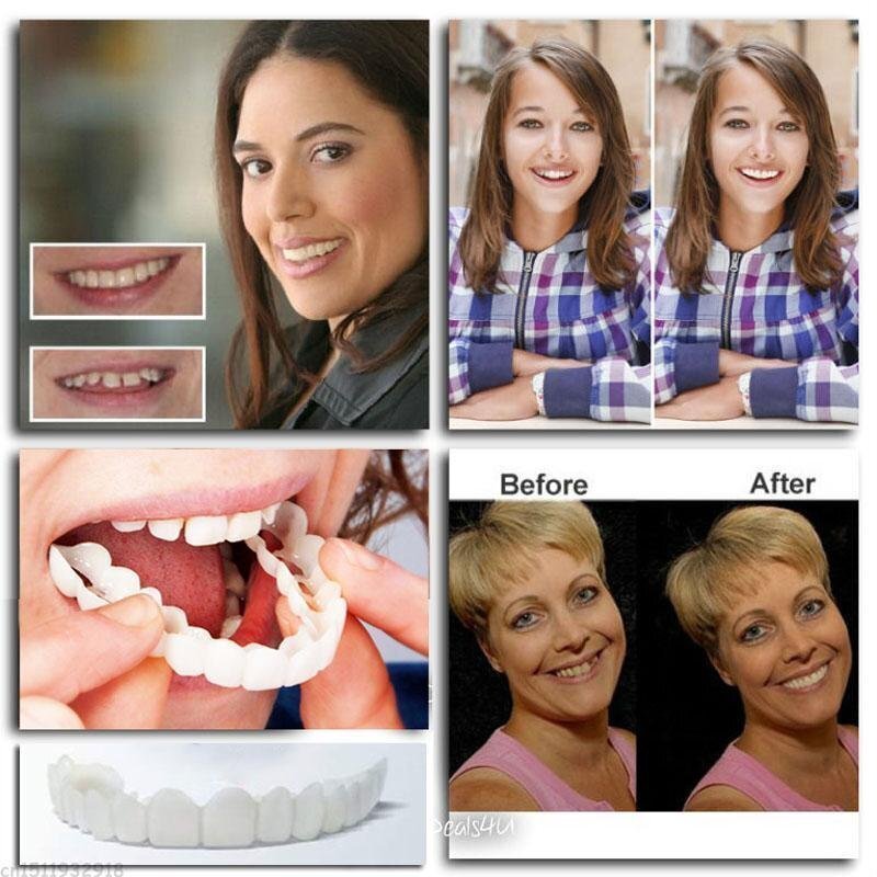 DentureSnap™ – Sofortige Snap-On-Veneers