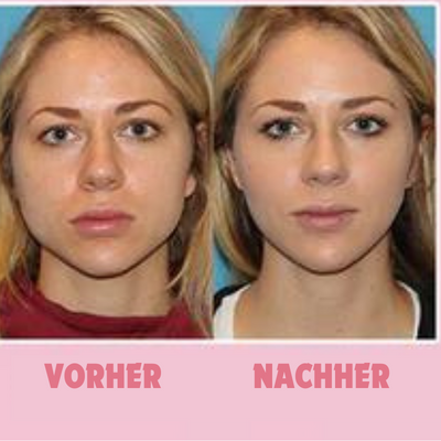 1+1 Gratis | FaceShape - Vakuum-Gesichtstrainer