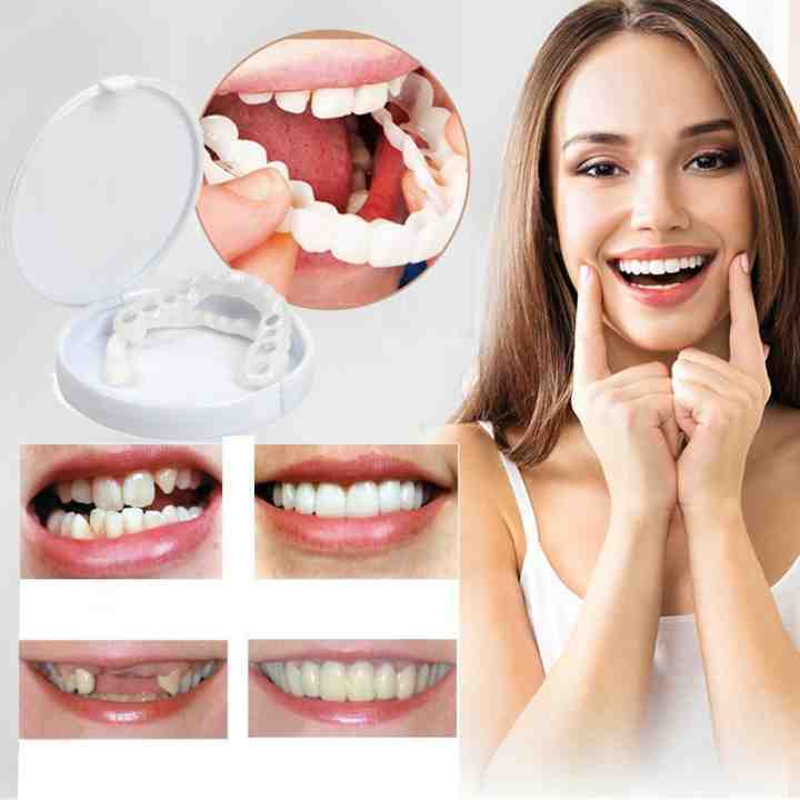 DentureSnap™ – Sofortige Snap-On-Veneers