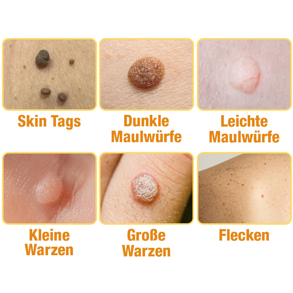 1+1 Gratis | DermiClear™ - Bienengift-Spray zur Entfernung von Warzen und Muttermalen
