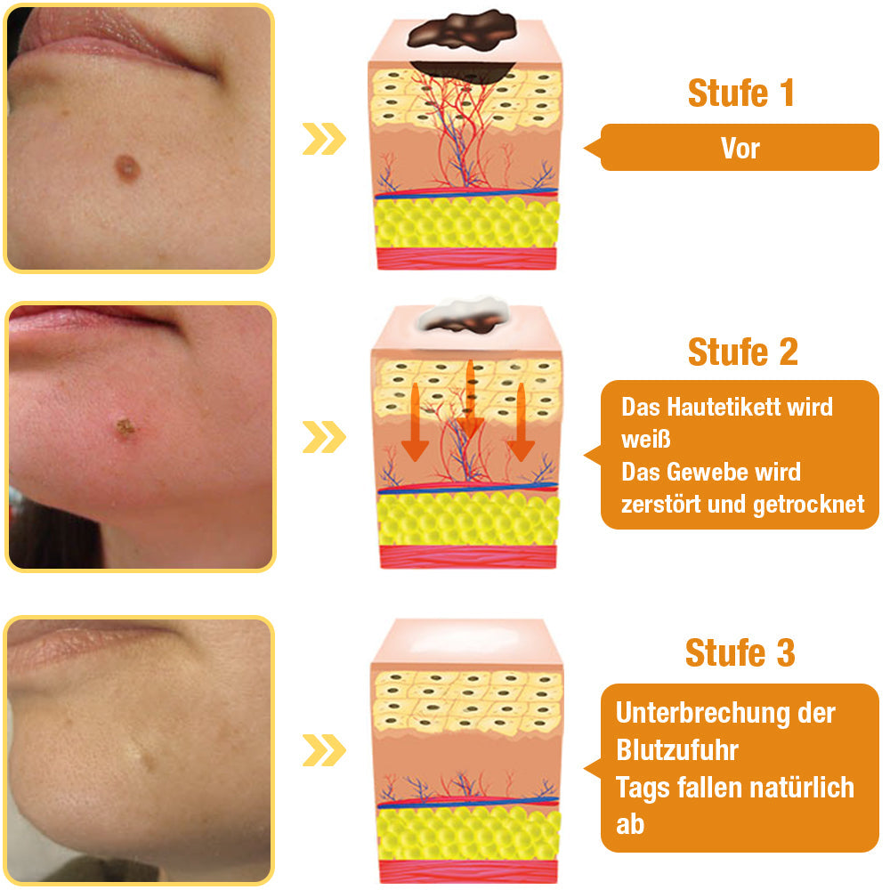 1+1 Gratis | DermiClear - Bienengift-Spray zur Entfernung von Warzen und Muttermalen