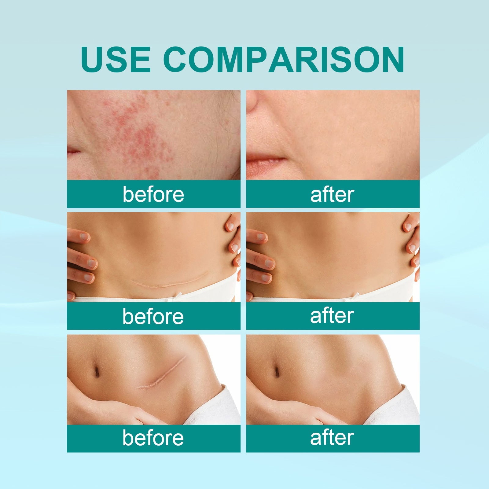ScarSpray™ - Narbenentferner