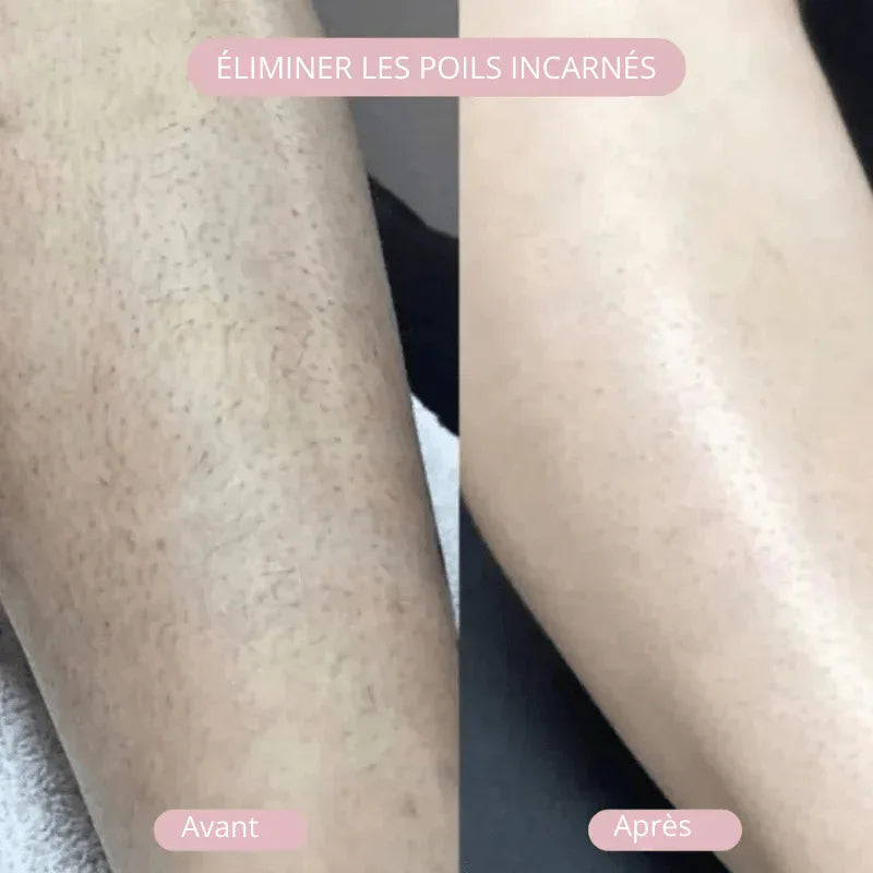 NuitLisse™ Épilation sans douleur pour une peau parfaitement lisse - Rondor