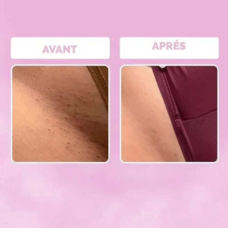 NuitLisse™ Épilation sans douleur pour une peau parfaitement lisse - Rondor