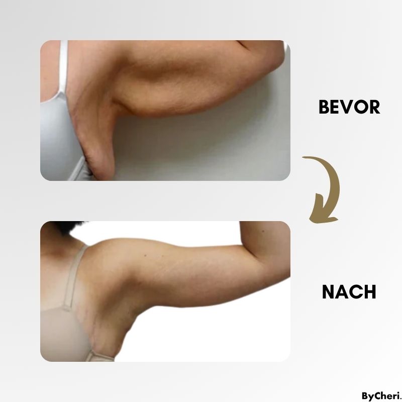 LymphMelt – Lymphstimulationsring zur Fettreduzierung und Entgiftung