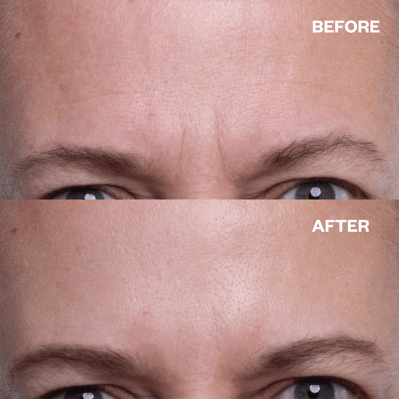 SilkSmoother™ – Silikonpflaster für die Nacht für faltenfreie Haut