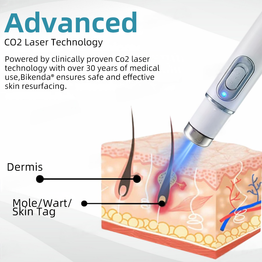 WartNoMore™ – Laser-Stift