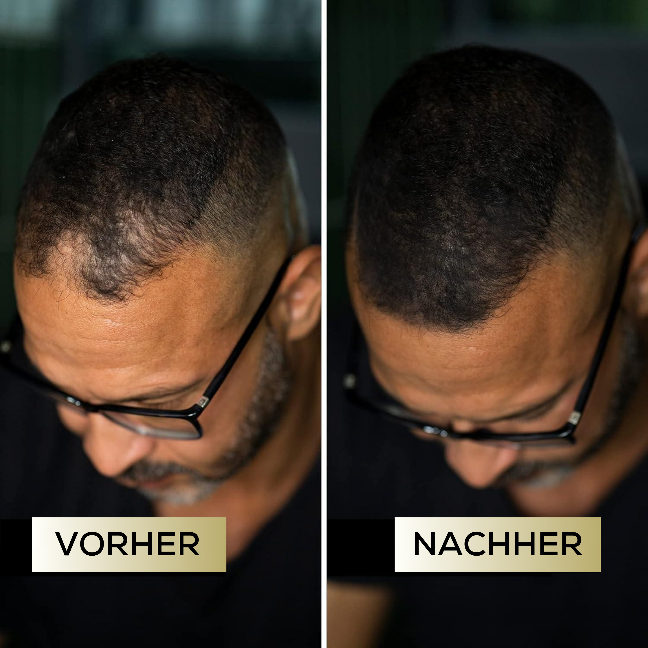 ScalpFiller™ – Unsichtbare Kopfhautfarbe für dichteres, volleres Haar