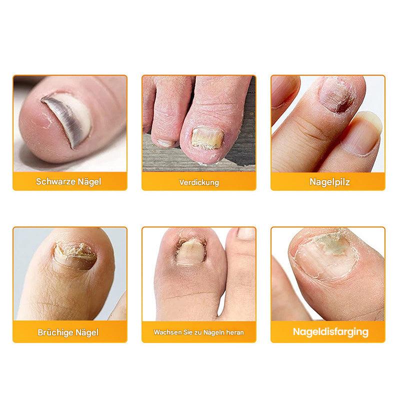 1+1 Gratis | Nailoxx™ – Diskrete antimykotische Nagelpflaster