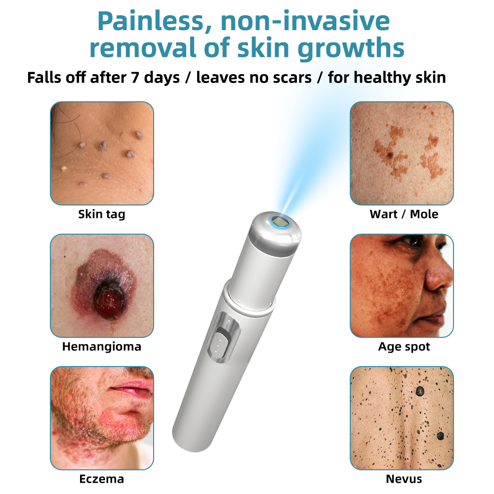 WartNoMore™ – Laser-Stift