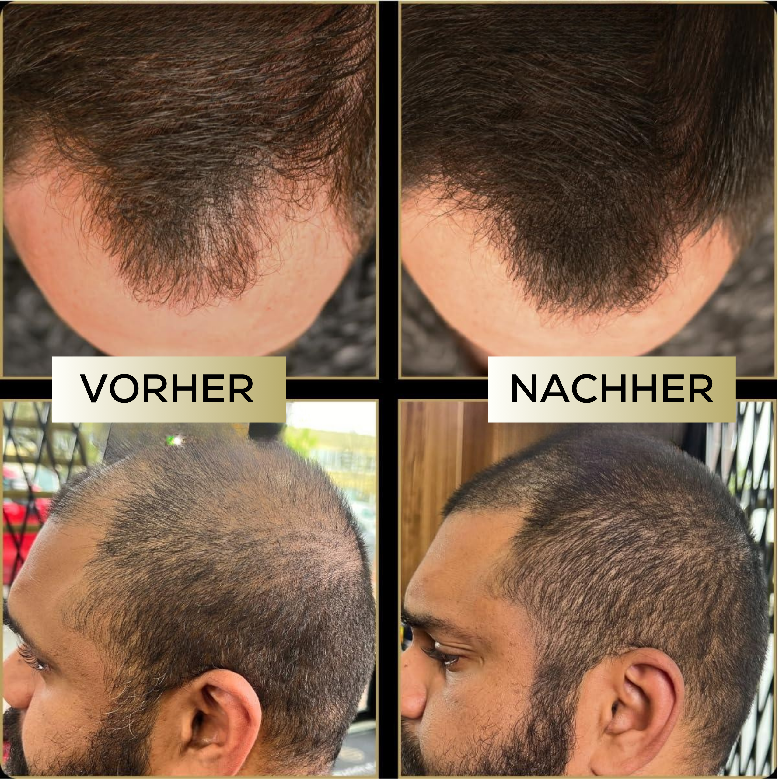 ScalpFiller™ – Unsichtbare Kopfhautfarbe für dichteres, volleres Haar