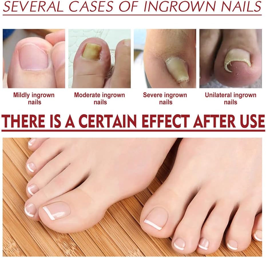 1+1 Gratis | DropToes™ – Nagelreparatur-Serum