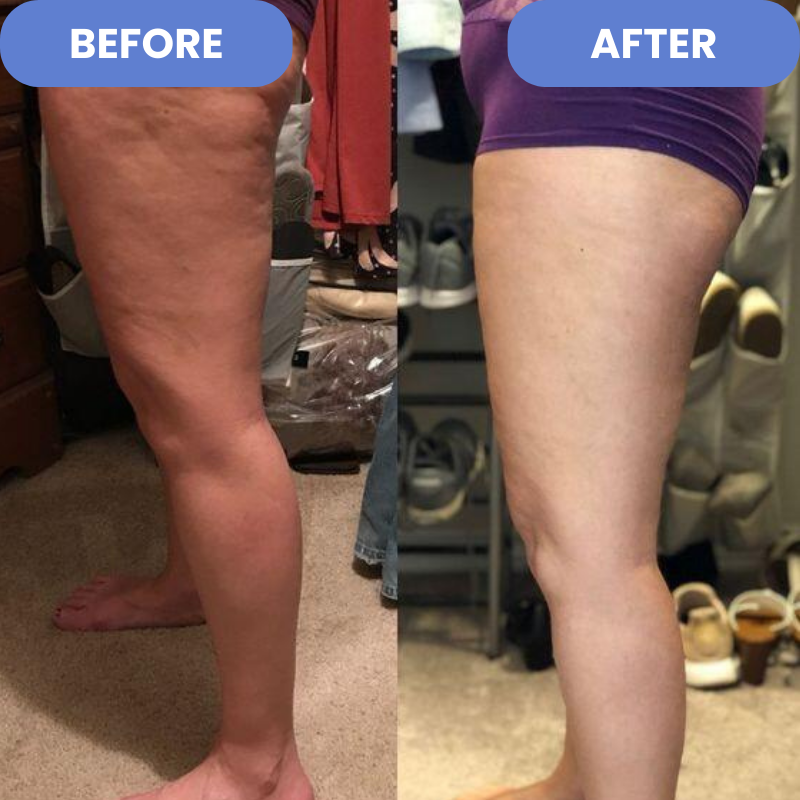 CelloSafe™ – Anti-Cellulite-Massagegerät