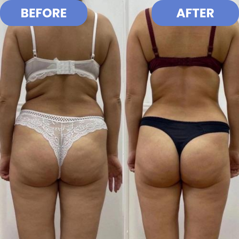 CelloSafe™ – Anti-Cellulite-Massagegerät