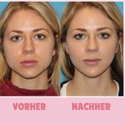 1+1 Gratis | FaceShape™ - Vakuum-Gesichtstrainer