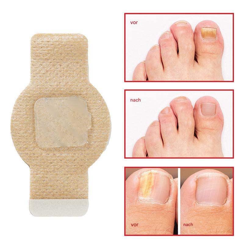 1+1 Gratis | Nailoxx™ – Diskrete antimykotische Nagelpflaster