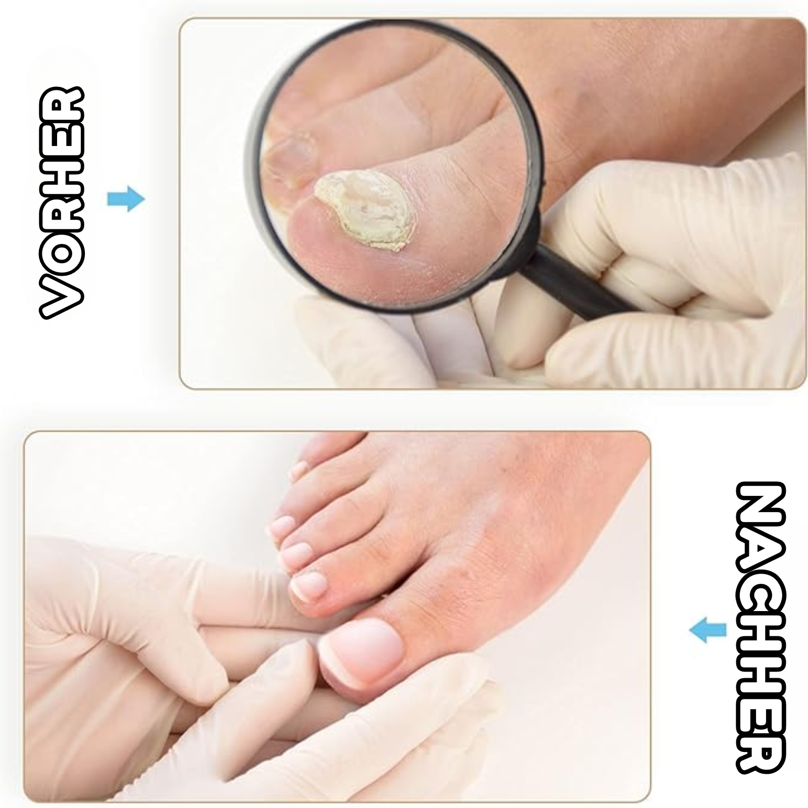 VitaNail™ - Nagelpflaster (Satz von 100 Pflastern)