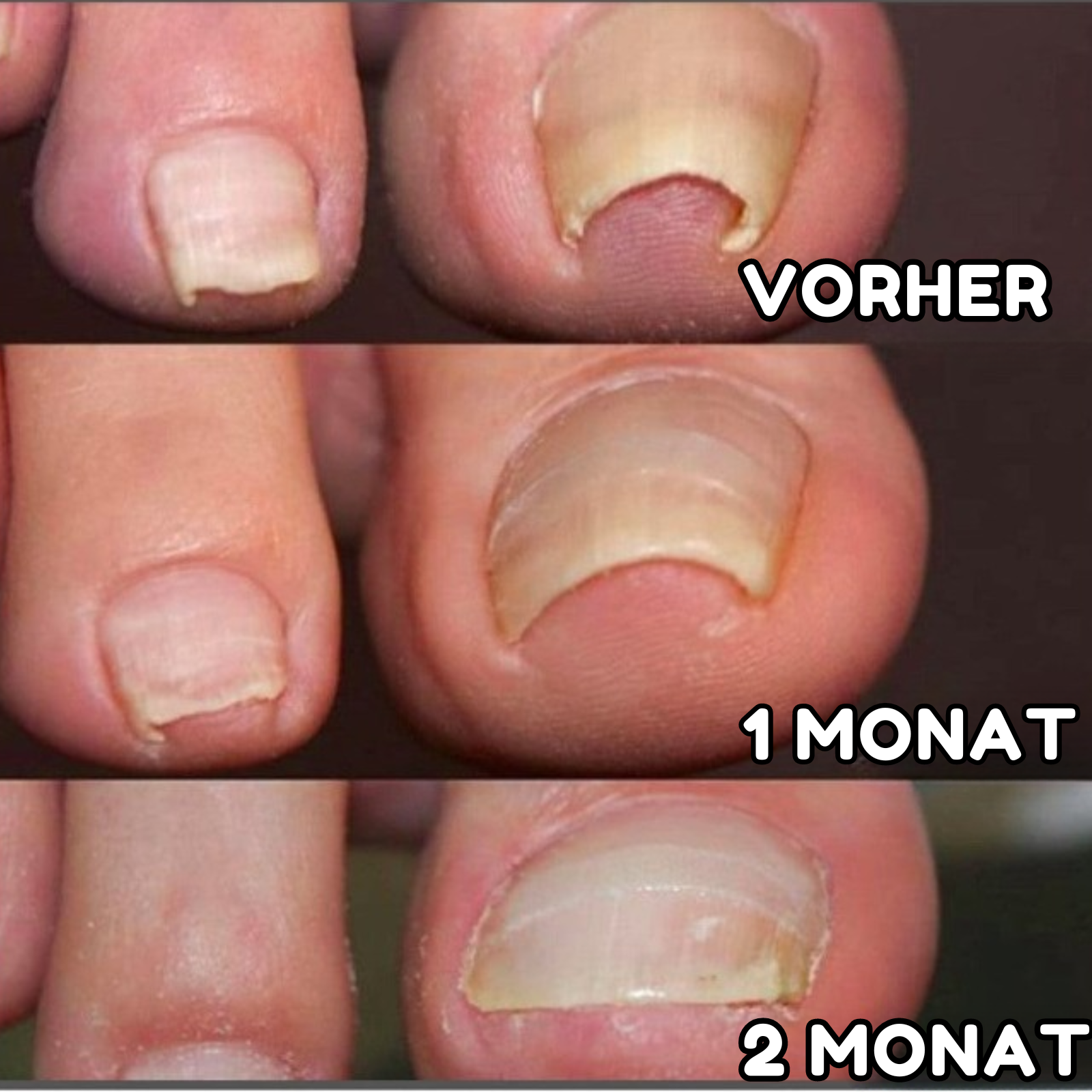 VitaNail™ - Nagelpflaster (Satz von 100 Pflastern)