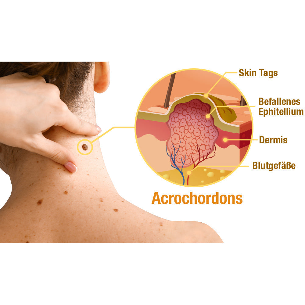 1+1 Gratis | DermiClear - Bienengift-Spray zur Entfernung von Warzen und Muttermalen