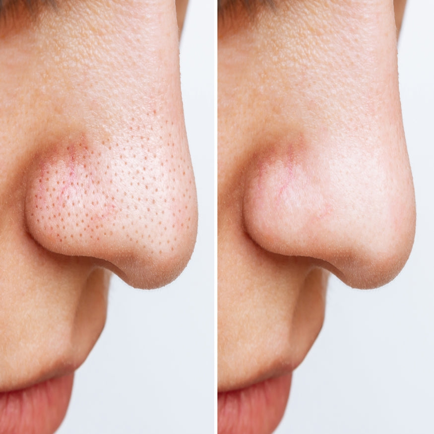1+1 Gratis | SkinClear - Mitesserentfernungscreme