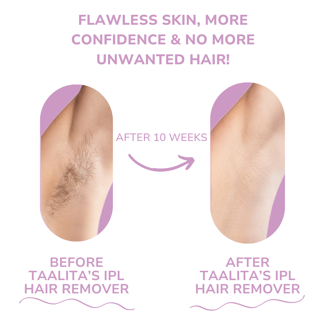 GlowSoft – Haarentfernungsgerät Schmerzfreier Laser-Haarentferner für Frauen und Männer