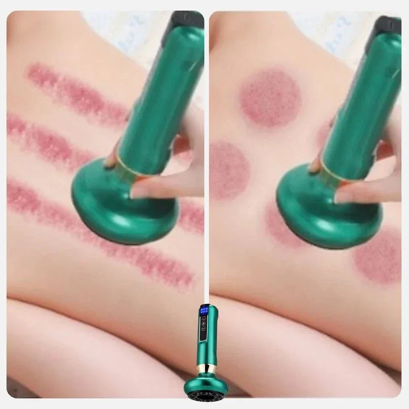 Appareil De Massage Avec Ventouse - Rondor