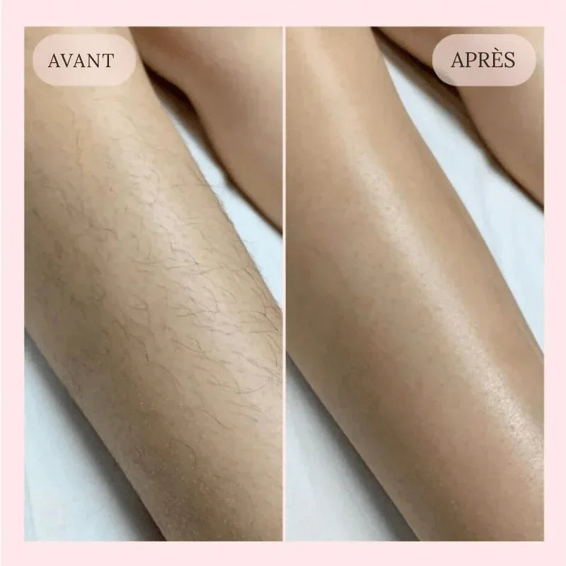 NuitLisse™ Épilation sans douleur pour une peau parfaitement lisse - Rondor