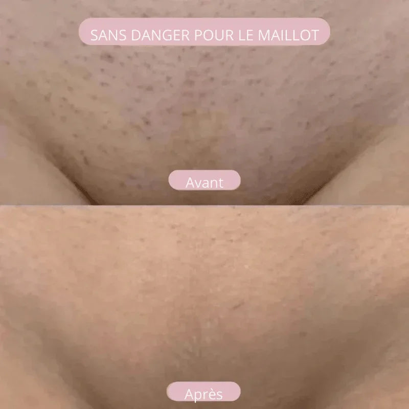 NuitLisse™ Épilation sans douleur pour une peau parfaitement lisse - Rondor